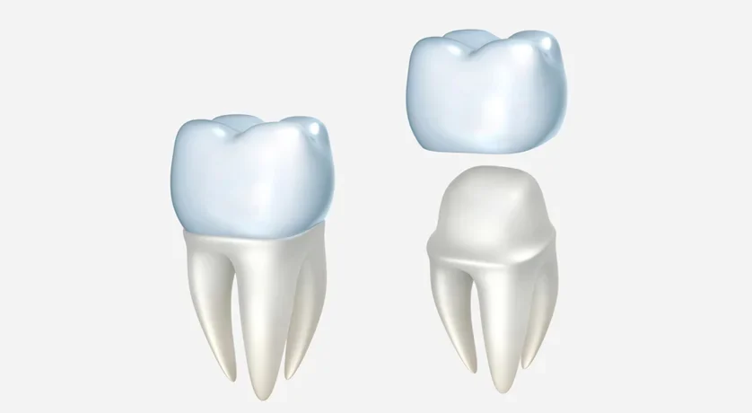 Dental Crowns