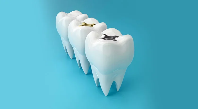 Dental-Fillings