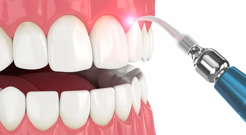 Periodontal-Treatment