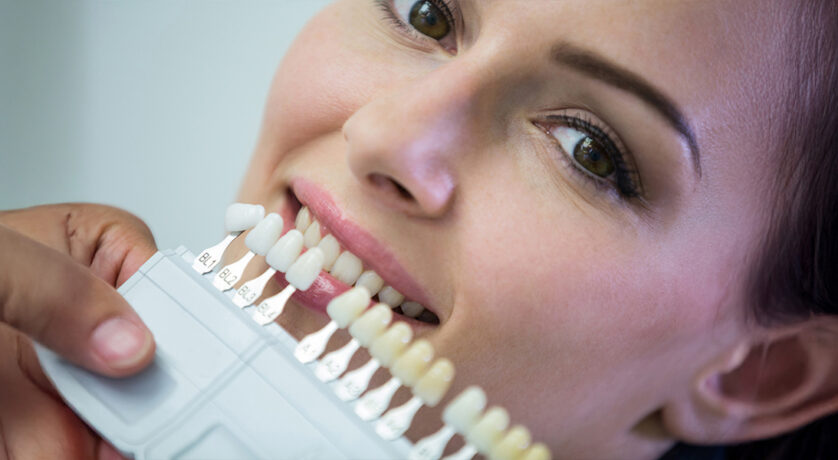 What Are Veneers? Benefits, Process & Results