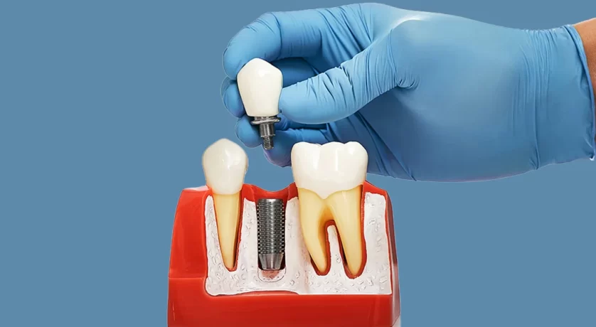 Dental-Implants-in-Ellicott-City
