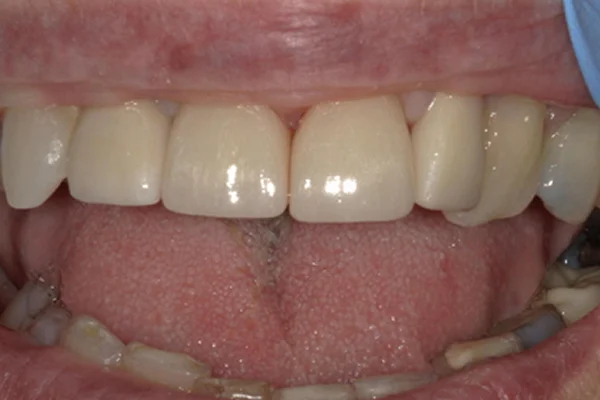 After image