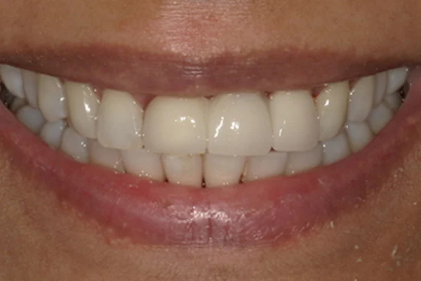 After image