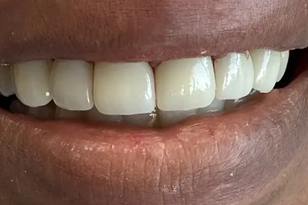 After image
